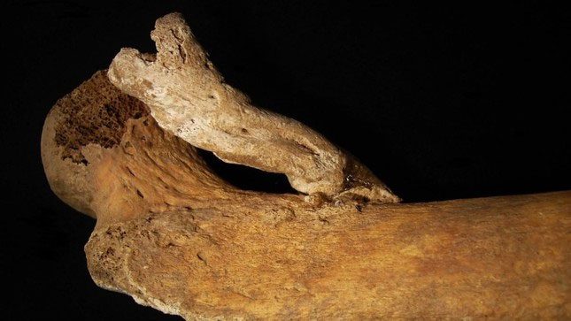 The bone mass with an 8cm tumor growing exactly where the pectineus muscle attaches to the femur