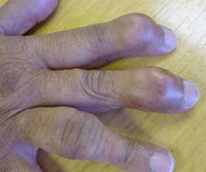 Symptoms in the hands of gout patients