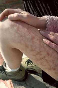 A patient suffering from Morgellons disease