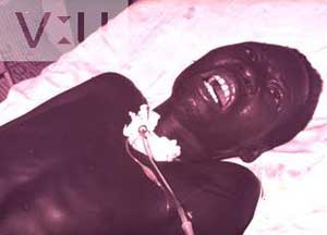 Rabies patient