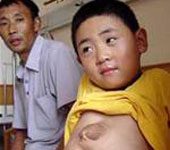 Trần Gia Khôn before the surgery