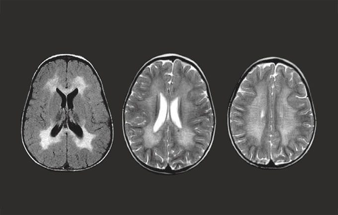 Brain of a person with metachromatic leukodystrophy.
