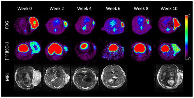 Brain scan showing the progression of a cancerous tumor over a period of 10 weeks.