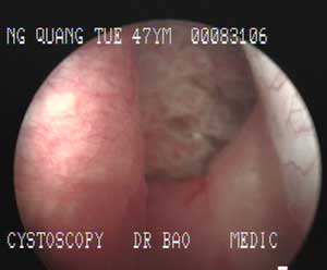 Bladder