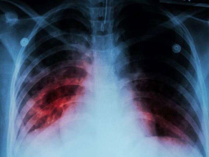 A tuberculosis case in the United States