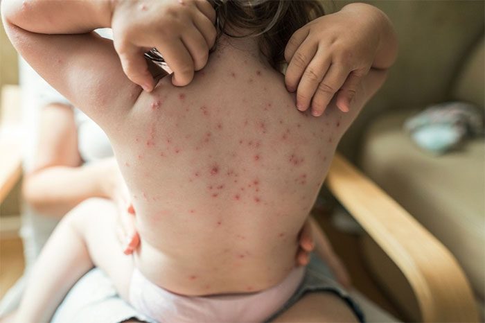Chickenpox is more common in children, while shingles is typically seen in older adults.