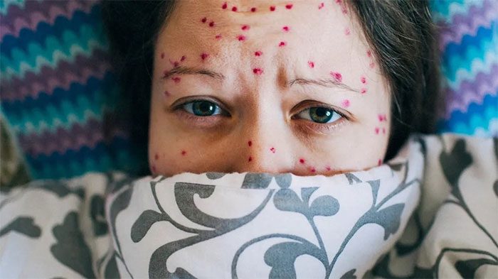 Chickenpox and shingles both present with rash symptoms on the body.