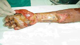 A burn victim at the National Burn Institute