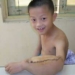 cat bo not khoi u 4 kg tren cau be muoi tuoi 6572
