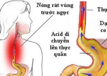 cat eating diet reducing symptoms unbearable people with acid reflux should know 126216