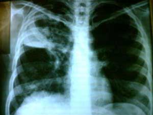 Chest X-ray