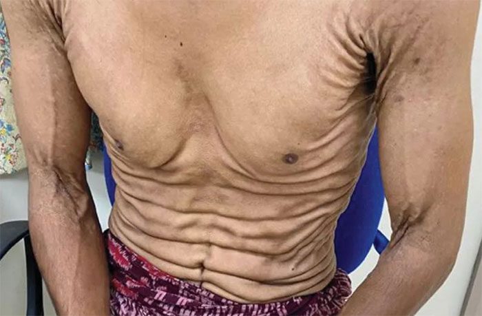 Loose skin forming large folds in a 27-year-old patient in Oman.