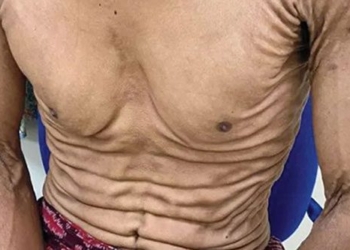 disease unique causes 27 year old young mans skin to burn 126171