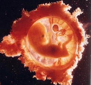 foetus1