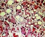 Cross-section image of a fatty liver showing white spots
