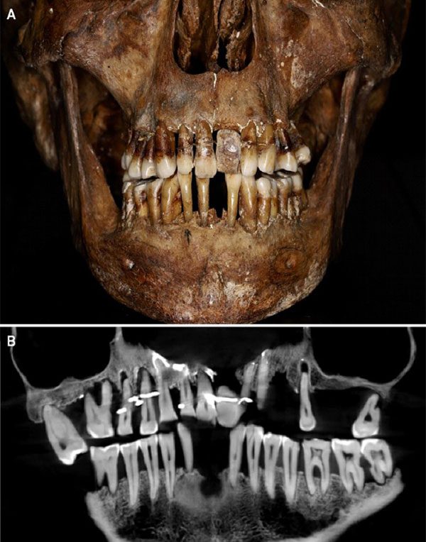Anne d'Alegre's teeth are still very well preserved.