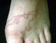 Hookworms enter the body through the skin