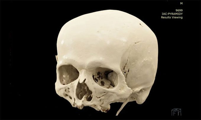 Skull of Gregor Mendel.
