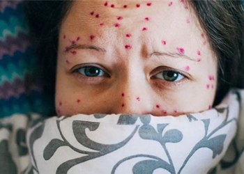 how to distinguish between chickenpox and shingles 125978