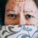 how to distinguish between chickenpox and shingles 125978