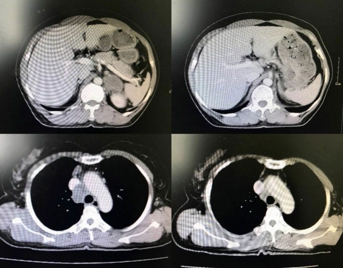 From left to right, top to bottom are images of the tumor at diagnosis and after treatment
