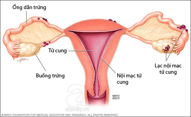 Endometriosis is common among women of reproductive age and rare in postmenopausal women.