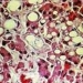 lack of nutrients can cause liver failure 7166