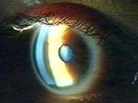 Eye tests may help detect signs of Alzheimer’s