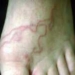 preventing intestinal worm infection 6824