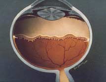 Retinopathy of Prematurity
