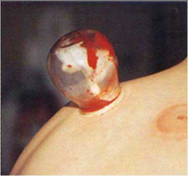 A person receiving a back massage to relieve a cold. This is also a risk factor for hepatitis C infection