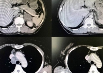 small lung cancer immunotherapy 125963