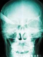 Stab wound - image captured via X-ray
