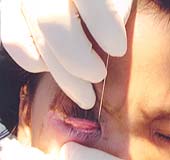 Customary practices for children with constant tearing.