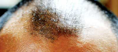 Baldness
