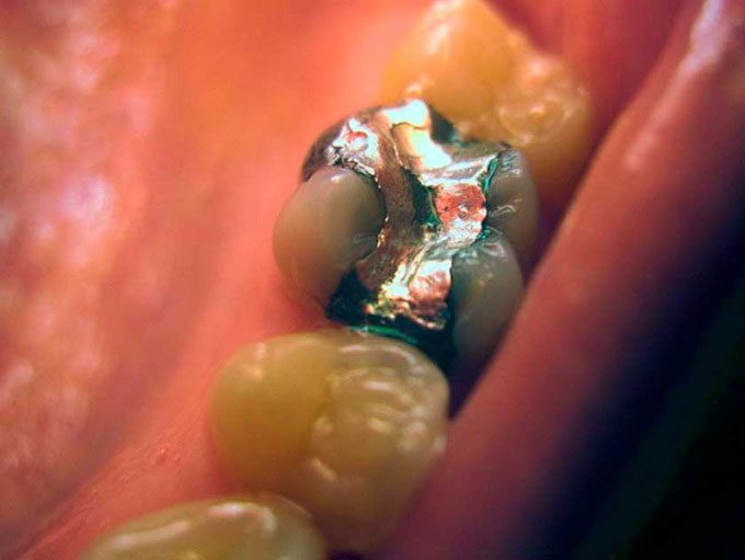 Improper filling techniques may be the cause of the exploding teeth phenomenon.