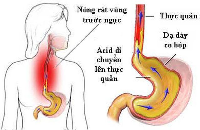Image of gastroesophageal reflux.
