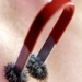treating diseases with acupuncture 6870