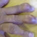 treatment for gout 6784