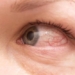 types of skin allergies and symptoms for accurate differentiation 125940