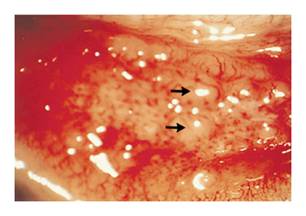 Conjunctivitis in newborns