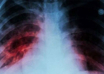 who warns of a disease that has killed more than covid 19 after 20 years 126547