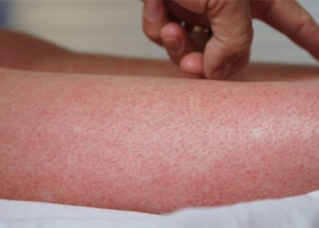3 dangerous diseases attacking civilians after flood 65067