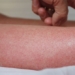 3 dangerous diseases attacking civilians after flood 65067