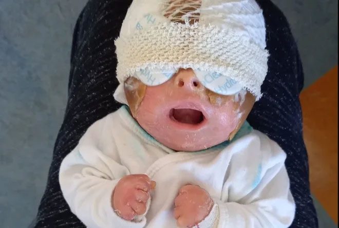 From birth, the skin on Elizabeth's face and chest hardened, causing her breathing difficulties.