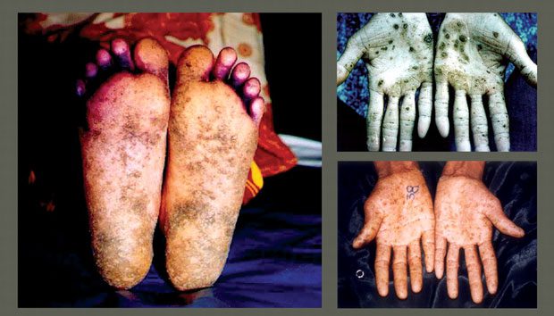 Absorbing 20mg of aflatoxin can lead to sudden death.