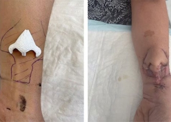 artificial nose grown on arm 124159