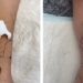 artificial nose grown on arm 124159
