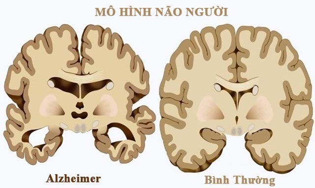 Alzheimer’s disease is a cause of memory loss.
