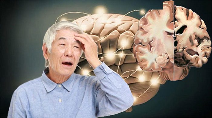 Alzheimer's disease typically progresses slowly.